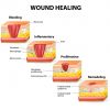 The following article and patient photographic diary shows the healing of a wound using a combined treatment approach of initial standard care for wound healing: oral antibiotics, MLD DLT, laser and as an adjunct, a MAGCELL® MICROCIRC (pulsed electromagnetic field therapy), which was carried out by the patient at home between 17th March 2020 and 10th May 2020, for up to 30 minutes daily, with nightly self-bandaging and elevation of foot in the daytime when possible.